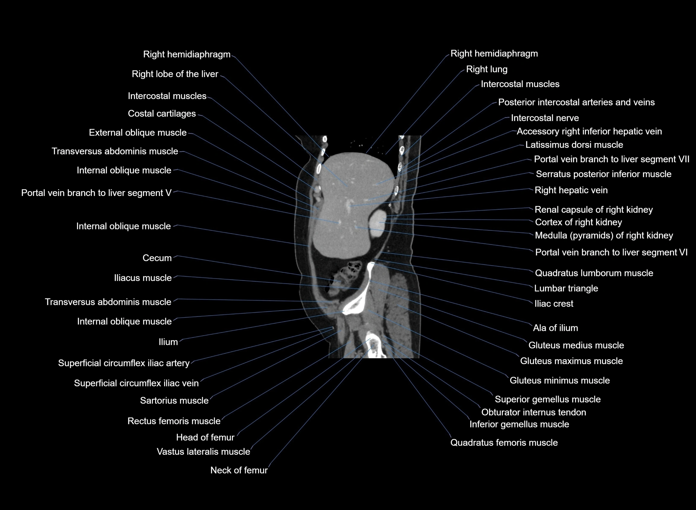 CT Abdomen sagittal cross sectional anatomy labelled radiology image -00091.webp